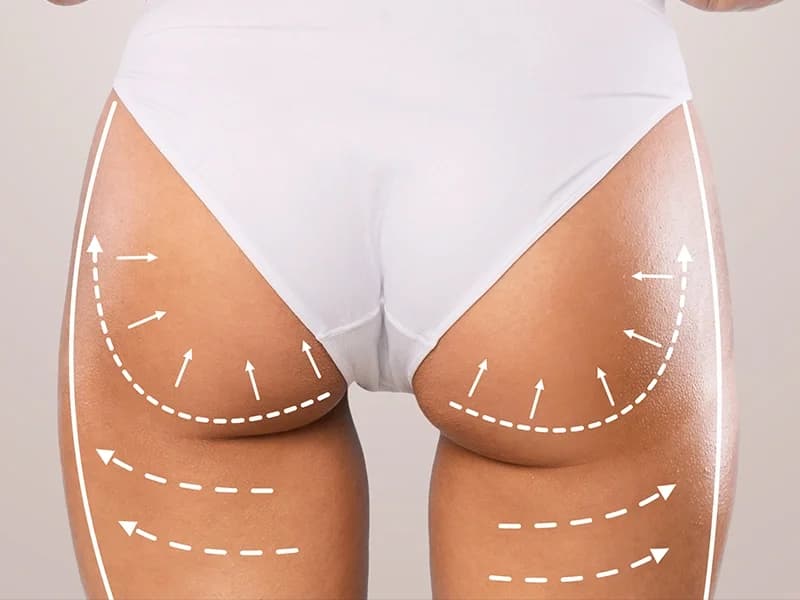 Brazilian Butt Lift in Turchia