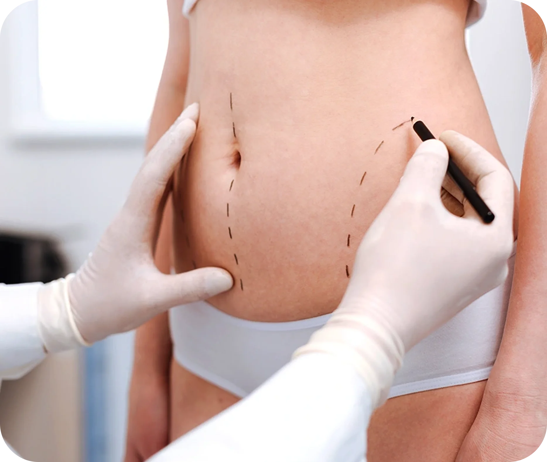 Procedura di liposuzione