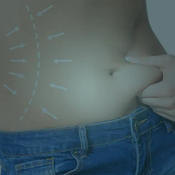 Bypass gastrico