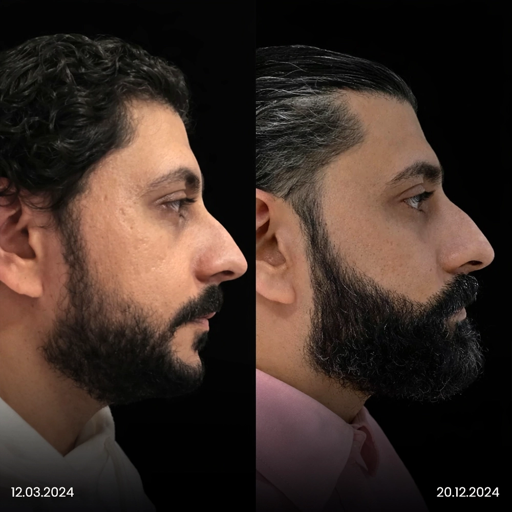 Risultato prima e dopo del trapianto di barba 1