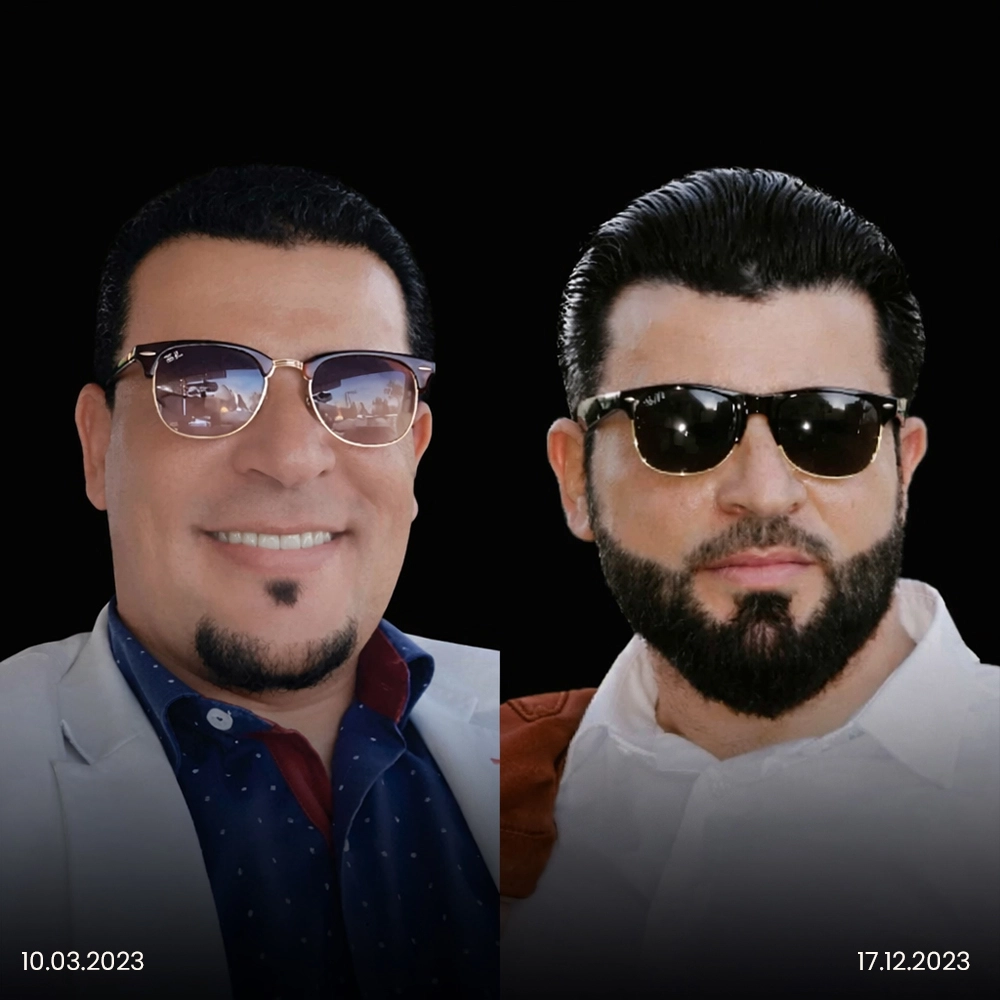 Risultato prima e dopo del trapianto di barba 2