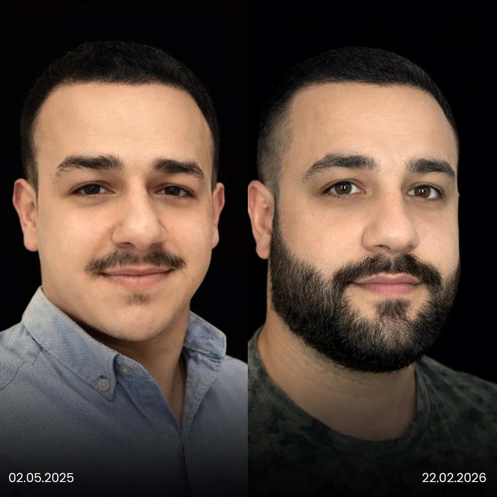 Risultato prima e dopo del trapianto di barba 3