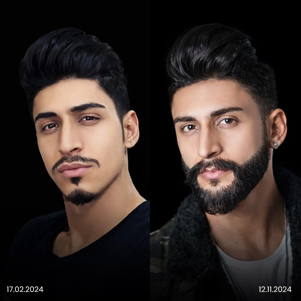 Risultato prima e dopo del trapianto di barba 4