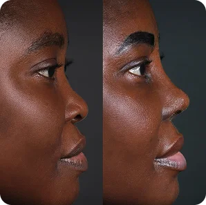 Risultato prima e dopo della rinoplastica presso Natural Clinic Turkey 1