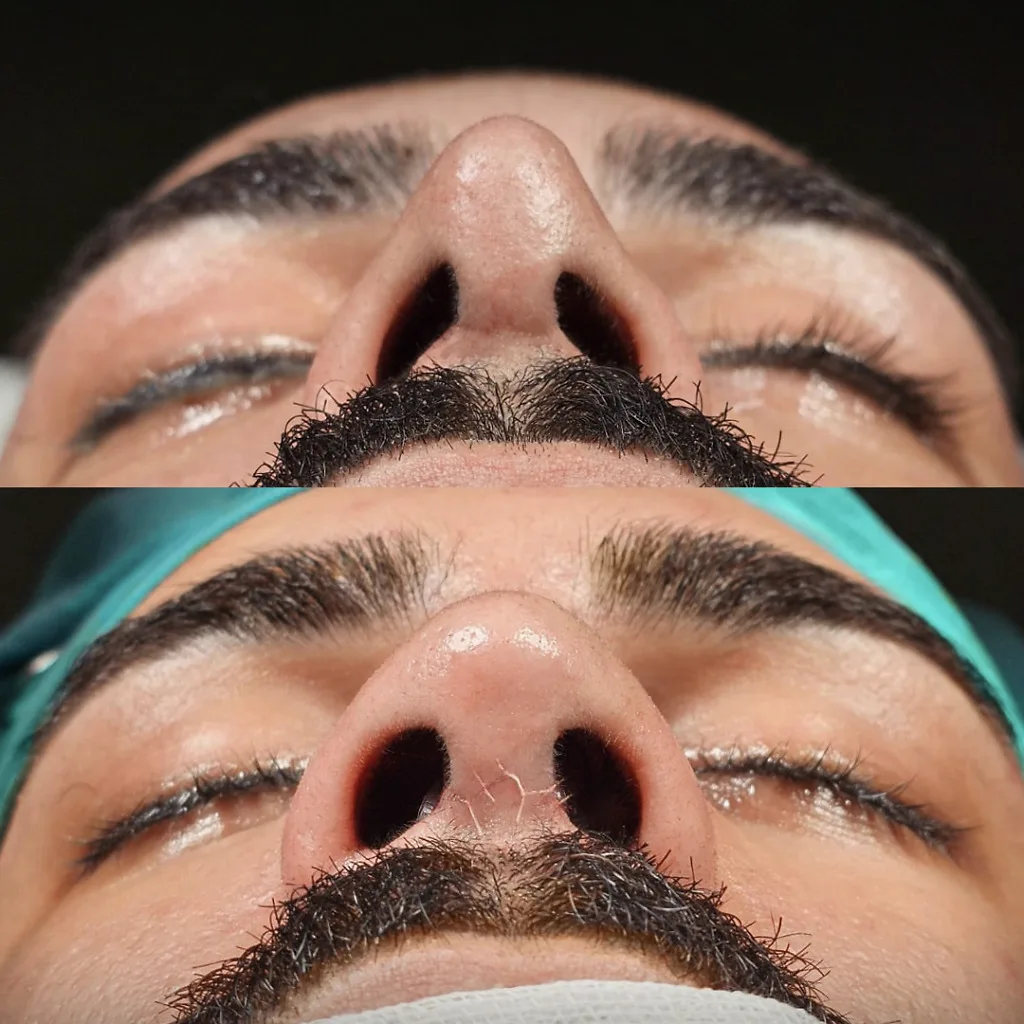 Risultato prima e dopo della rinoplastica presso Natural Clinic Turkey 3