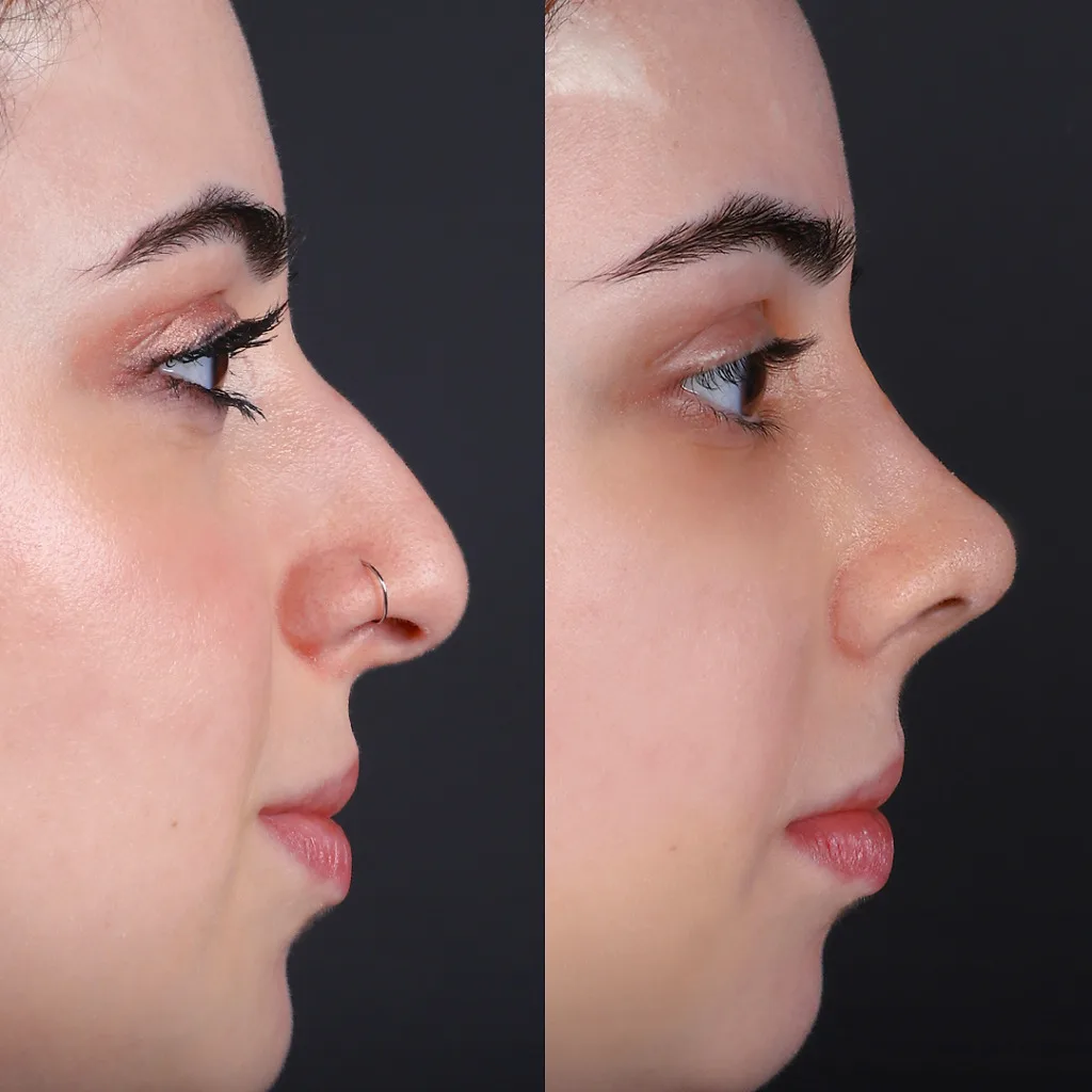 Risultato prima e dopo della rinoplastica presso Natural Clinic Turkey 4