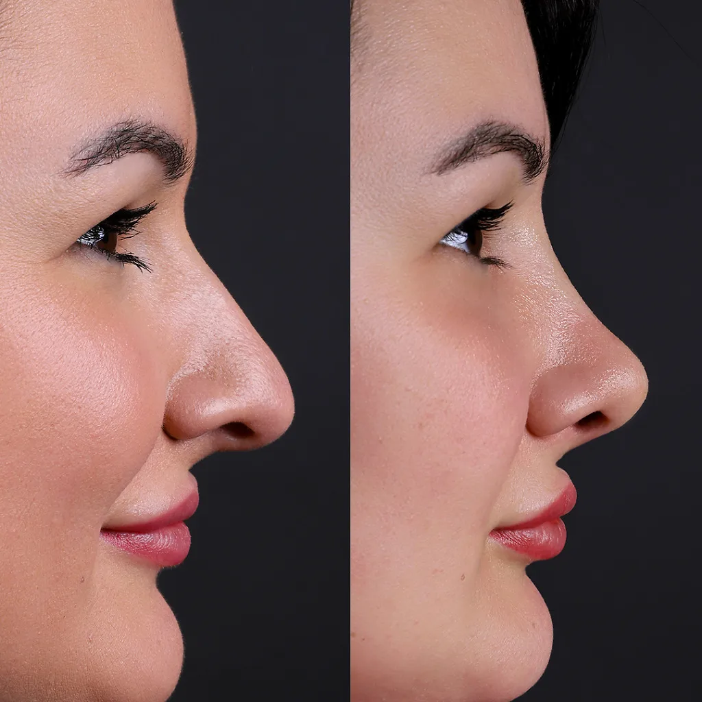 Risultato prima e dopo della rinoplastica presso Natural Clinic Turkey 5