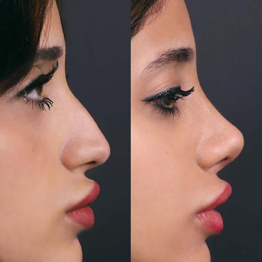 Risultato prima e dopo della rinoplastica presso Natural Clinic Turkey 6