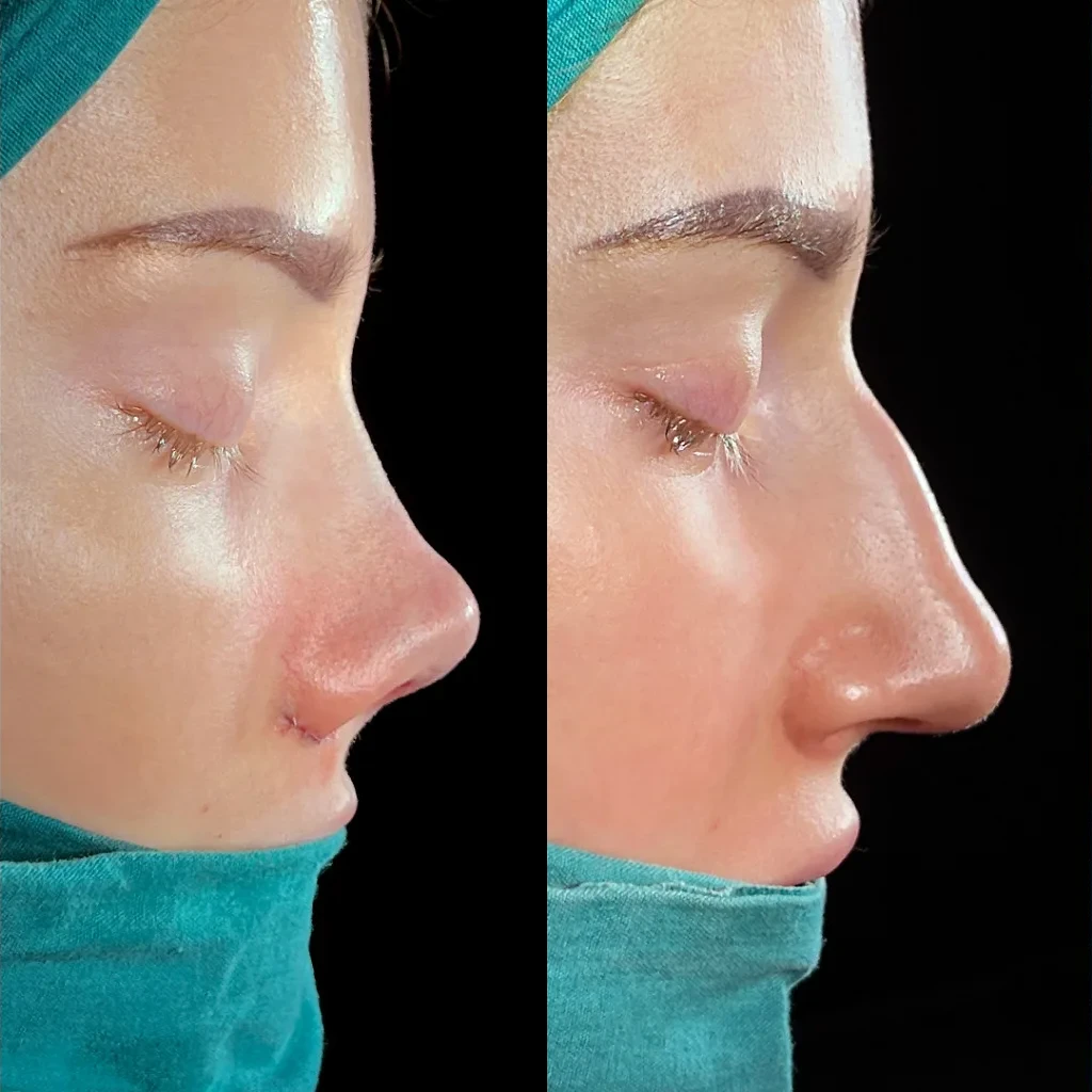 نتیجه قبل و بعد جراحی بینی (رینوپلاستی) در Natural Clinic ترکیه 2