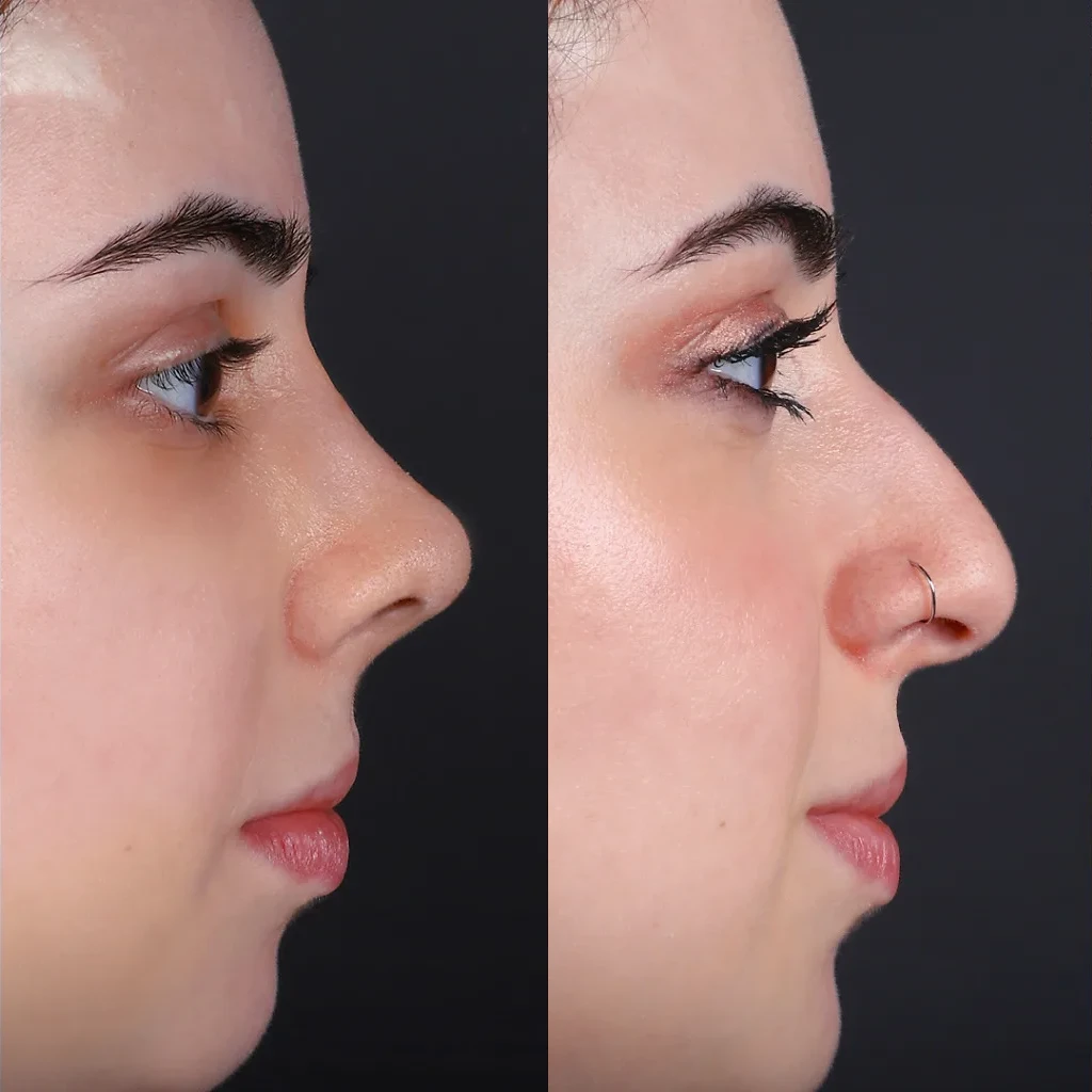 نتیجه قبل و بعد جراحی بینی (رینوپلاستی) در Natural Clinic ترکیه 4
