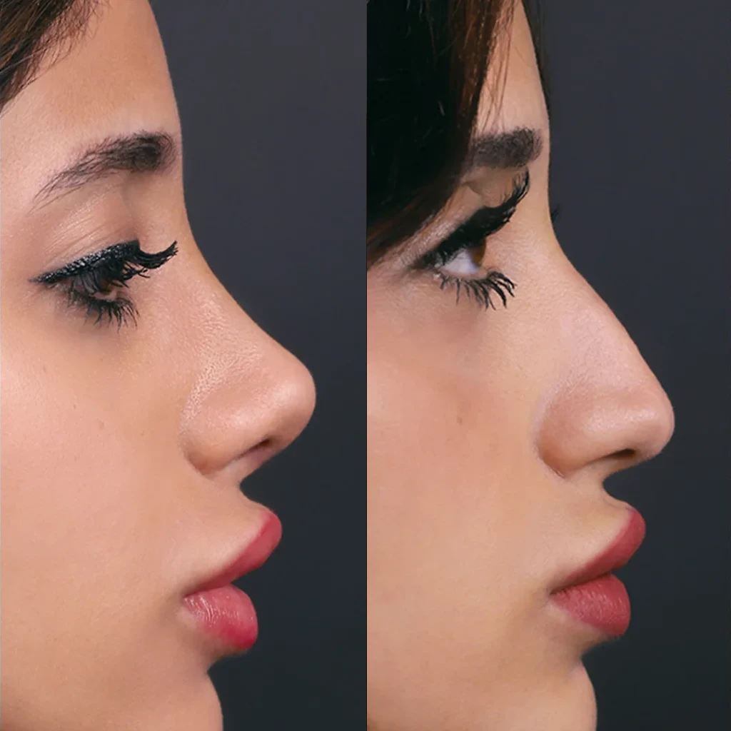 نتیجه قبل و بعد جراحی بینی (رینوپلاستی) در Natural Clinic ترکیه 6