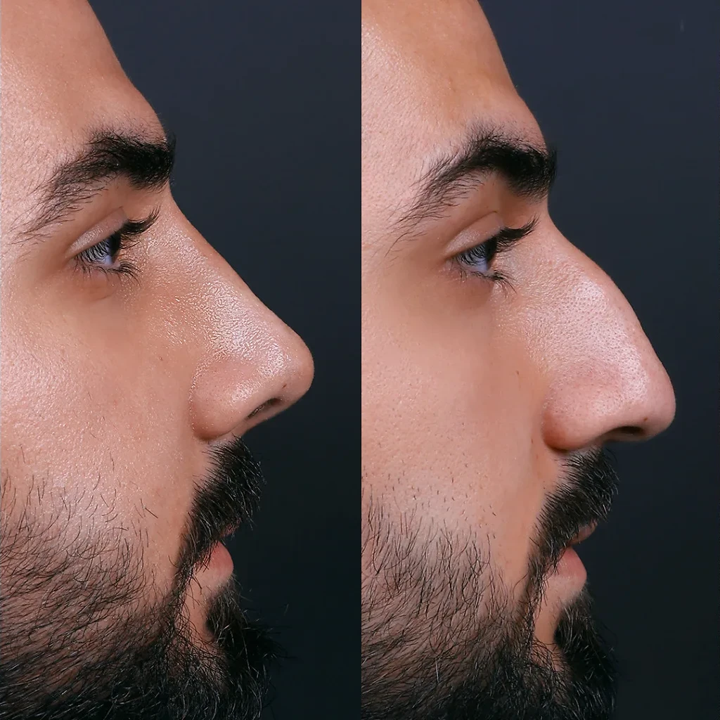 نتیجه قبل و بعد جراحی بینی (رینوپلاستی) در Natural Clinic ترکیه 7