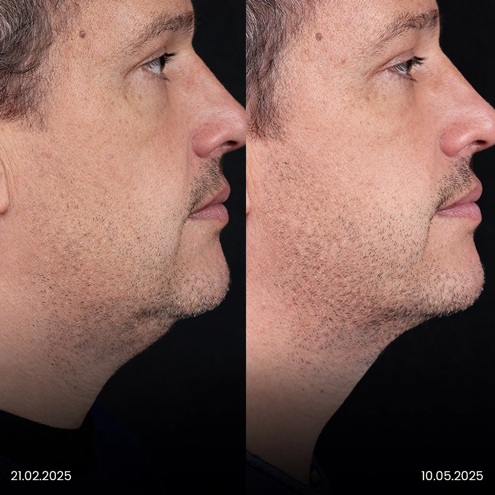 Risultato prima e dopo della liposuzione del mento 2