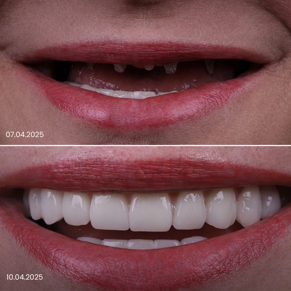 Risultato prima e dopo delle corone dentali 5