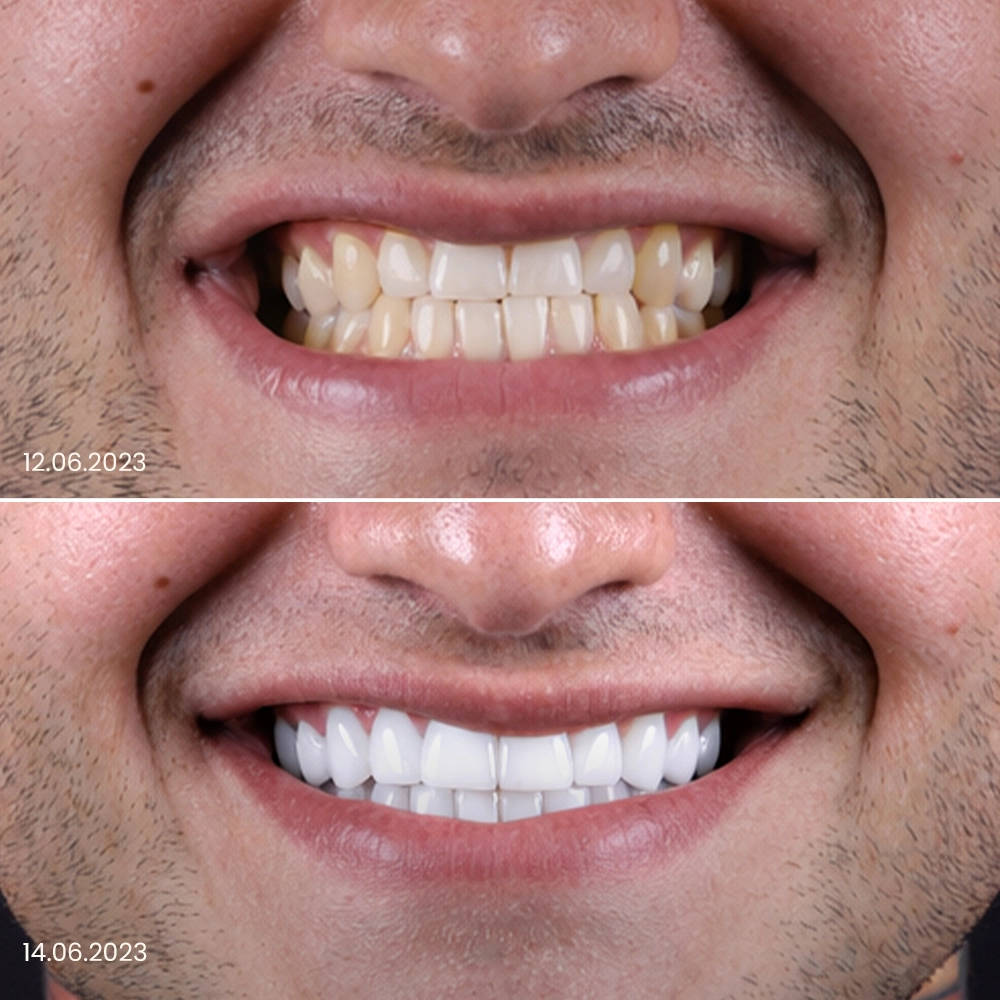 Risultato prima e dopo delle corone dentali 1