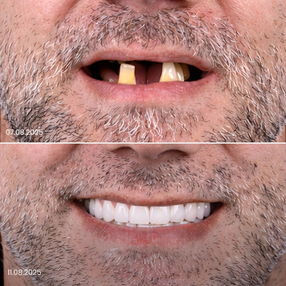 Risultato prima e dopo delle corone dentali 2
