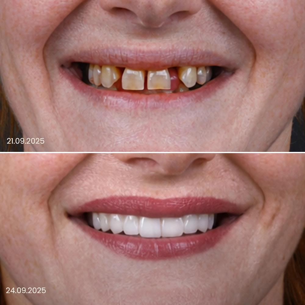 Risultato prima e dopo delle corone dentali 4