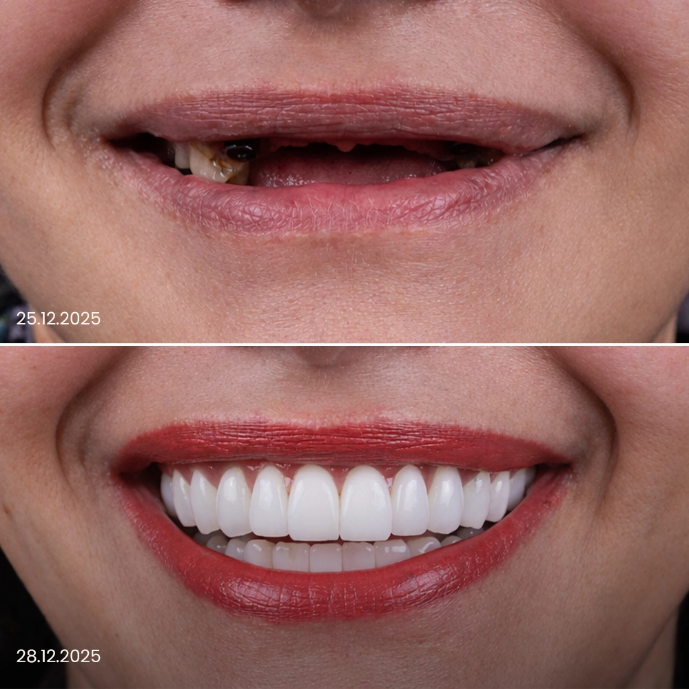 Impianti dentali prima e dopo, risultato 2 in Turchia
