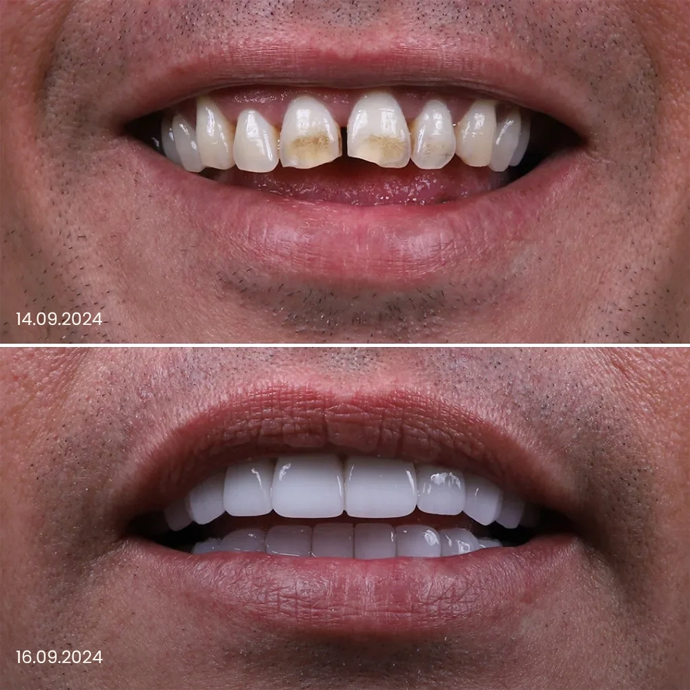 Faccette dentali prima e dopo, risultato 1