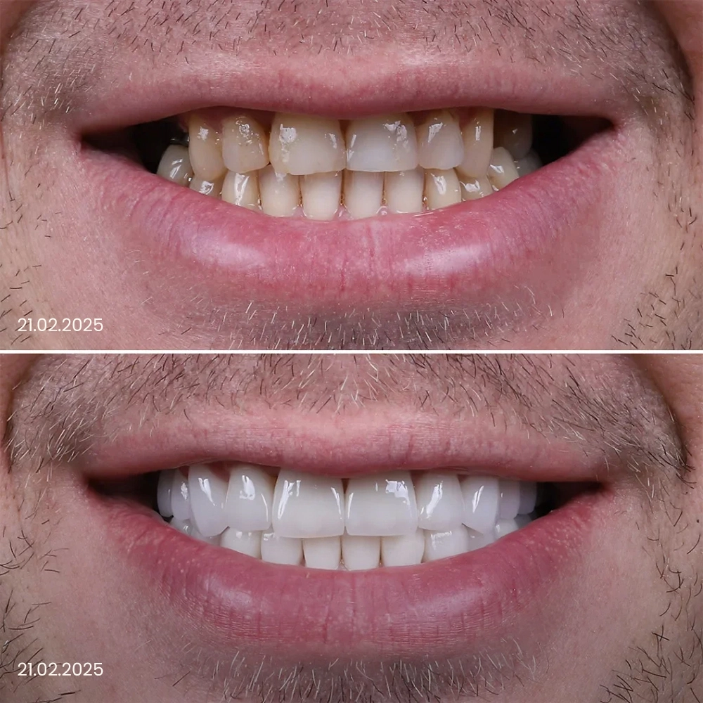 Faccette dentali prima e dopo, risultato 2