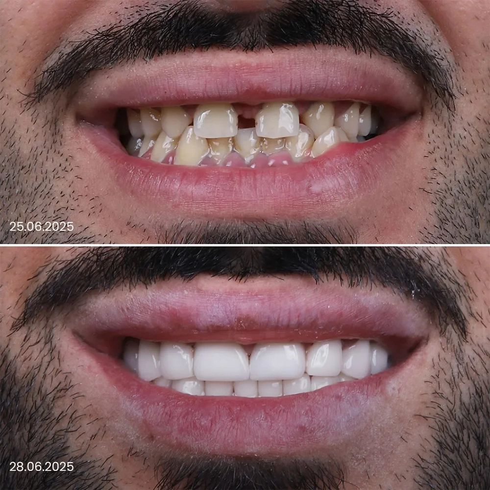 Faccette dentali prima e dopo, risultato 4