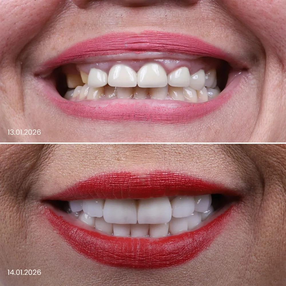 Faccette dentali prima e dopo, risultato 5