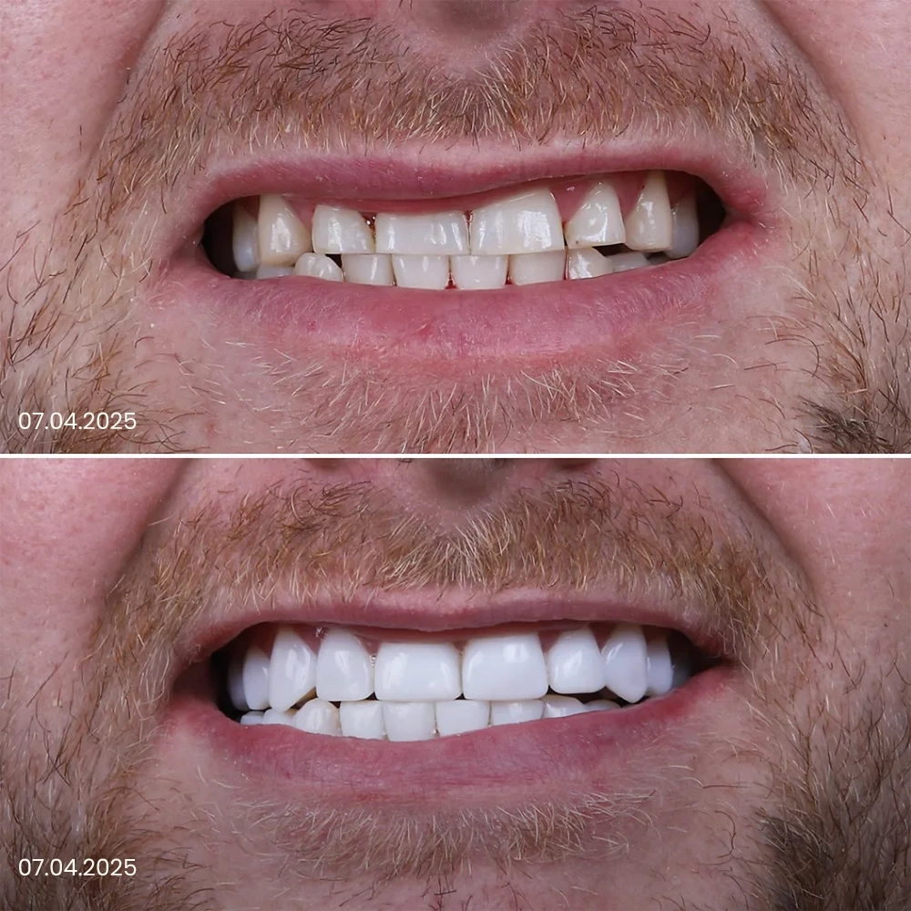 Faccette dentali prima e dopo, risultato 6