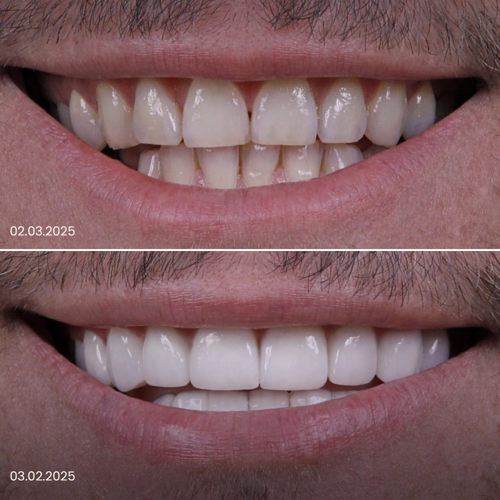 Faccette dentali prima e dopo, risultato 8