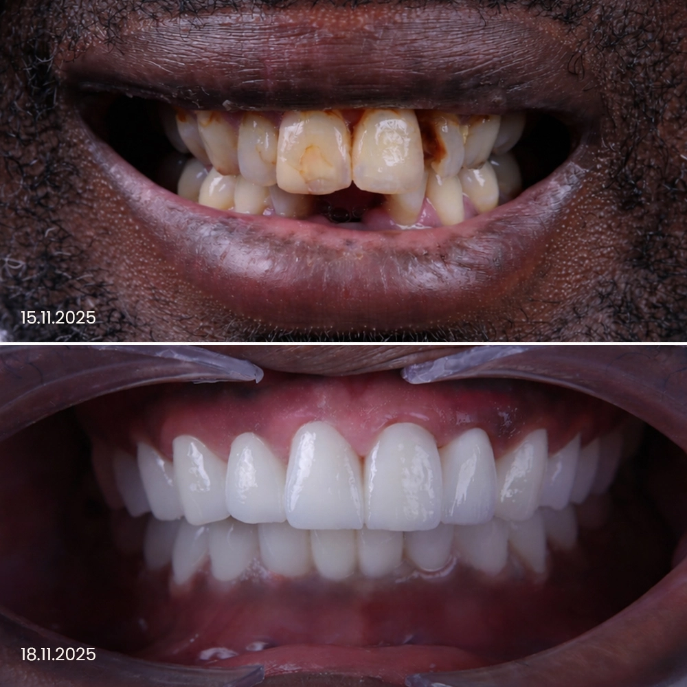 Faccette dentali prima e dopo, risultato 9