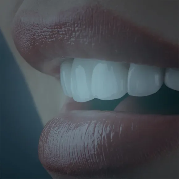 Hollywood Smile