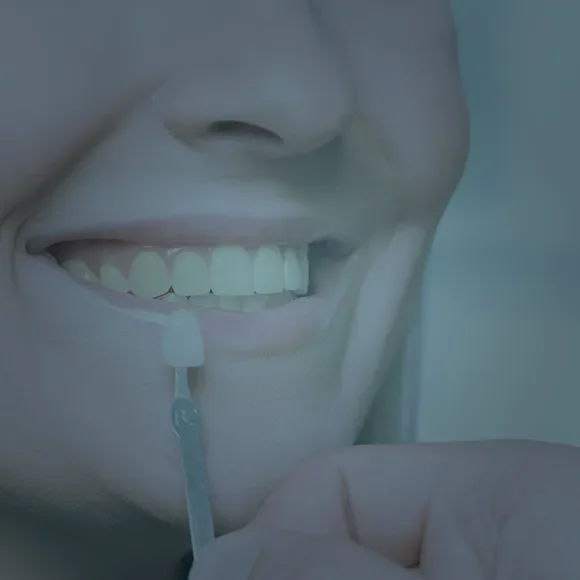 Faccette dentali