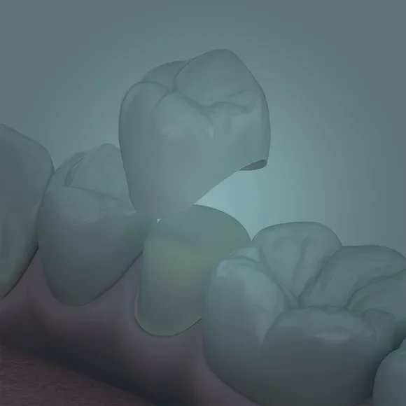 Corone dentali