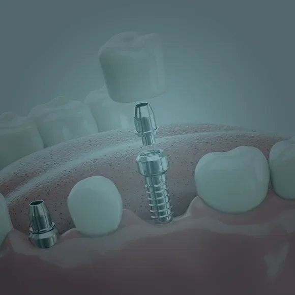 Impianti dentali
