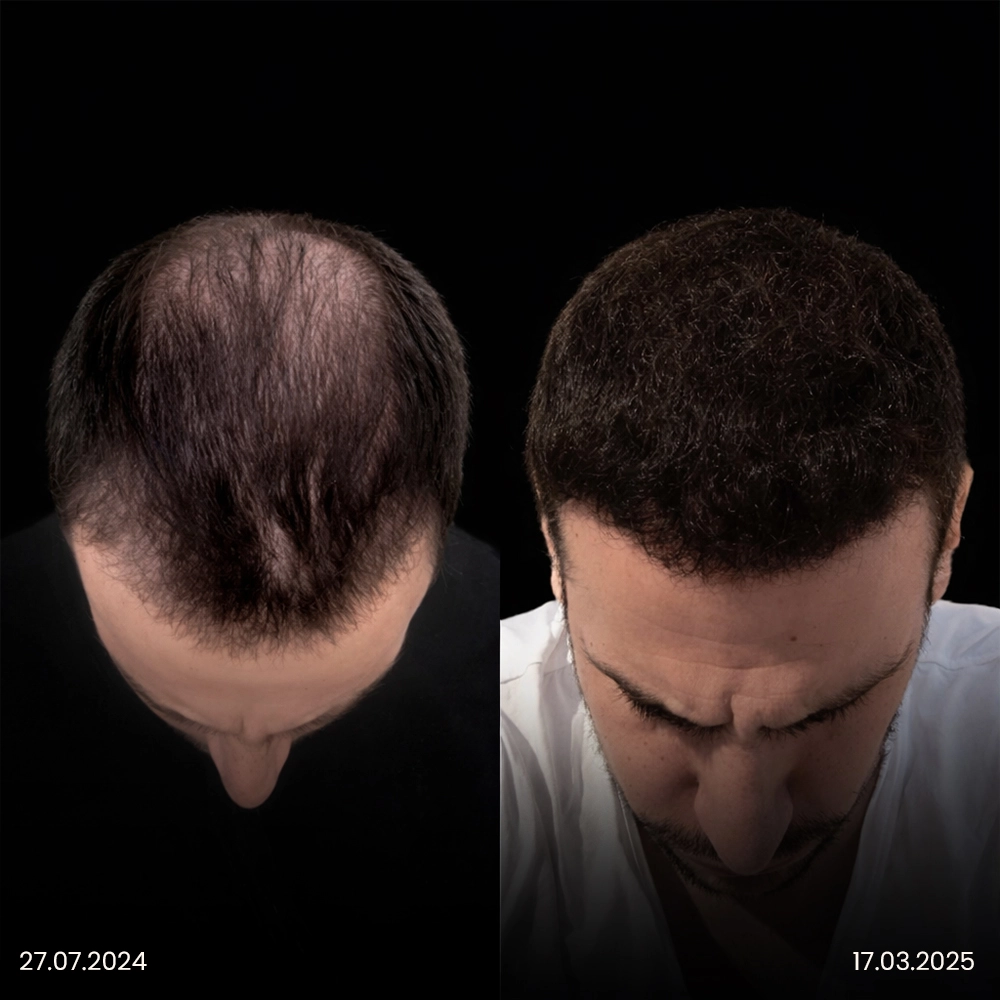 Risultato prima e dopo del trapianto di capelli DHI 11