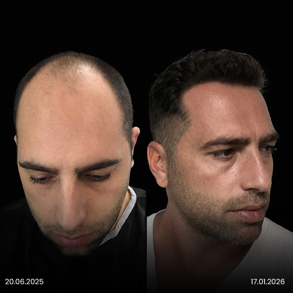 Risultato prima e dopo del trapianto di capelli DHI 13