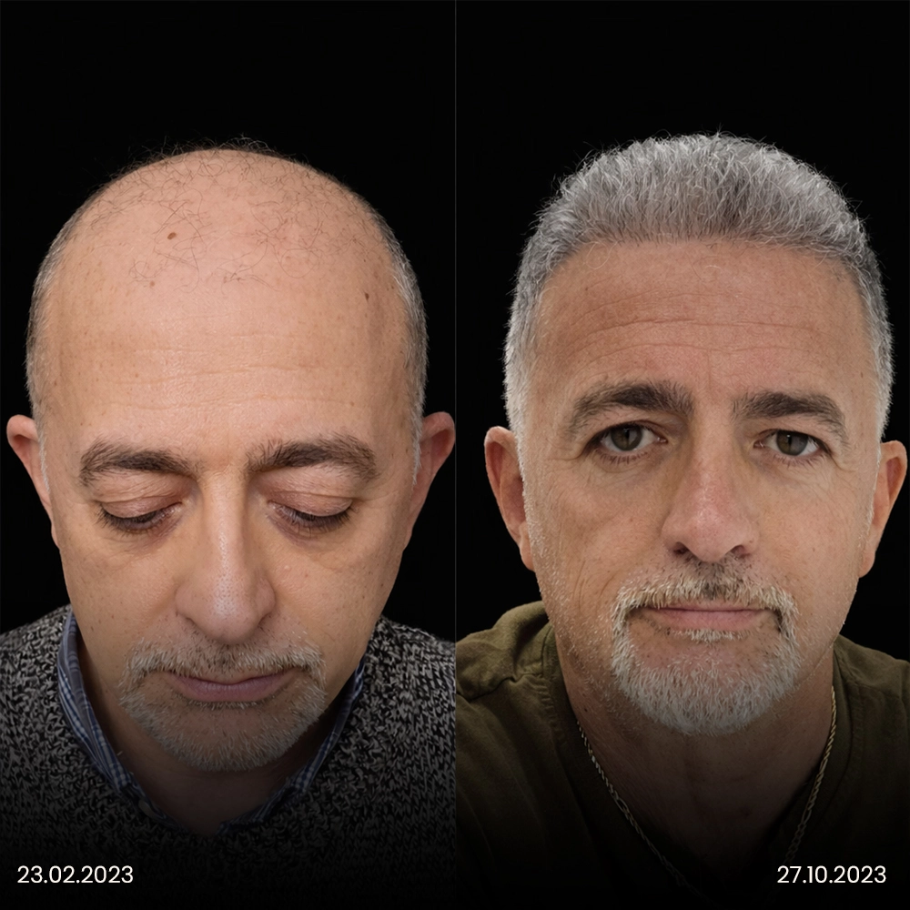 Risultato prima e dopo del trapianto di capelli DHI 4-1