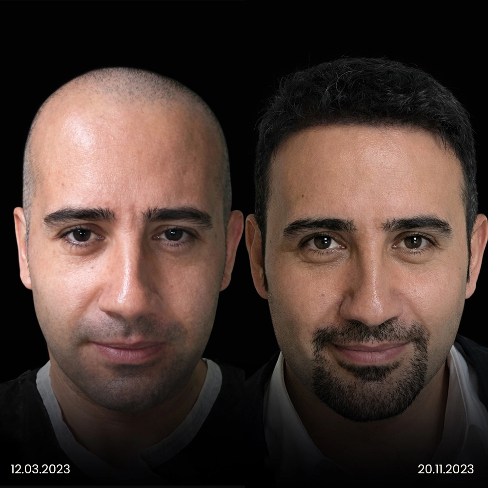 Risultato prima e dopo del trapianto di capelli DHI 6