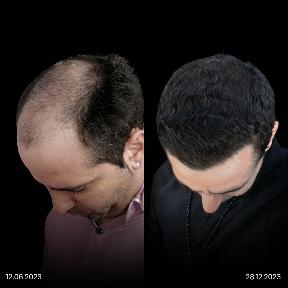 Risultato prima e dopo del trapianto di capelli DHI 8