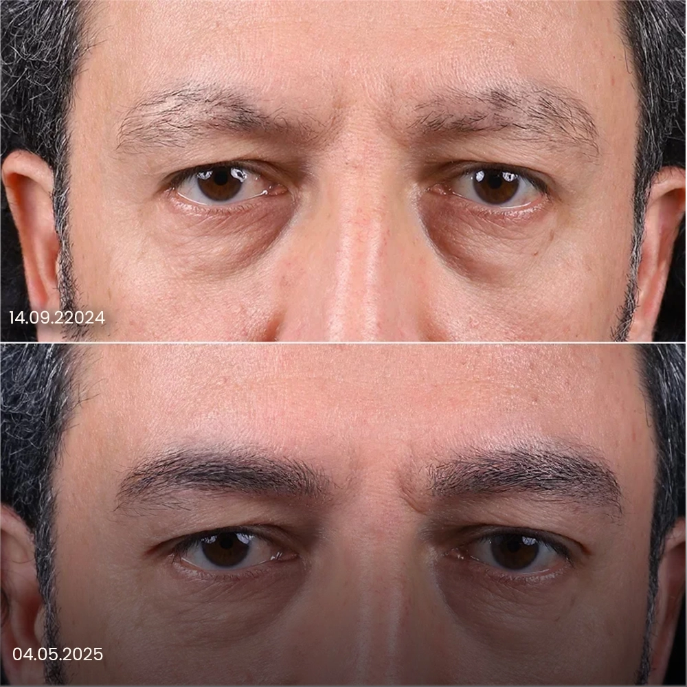 Risultato prima e dopo del trapianto di sopracciglia 4