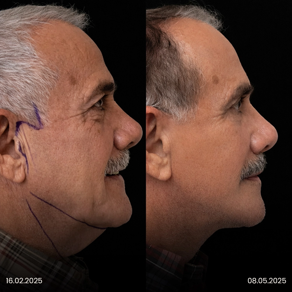 Risultato prima e dopo del lifting facciale 1