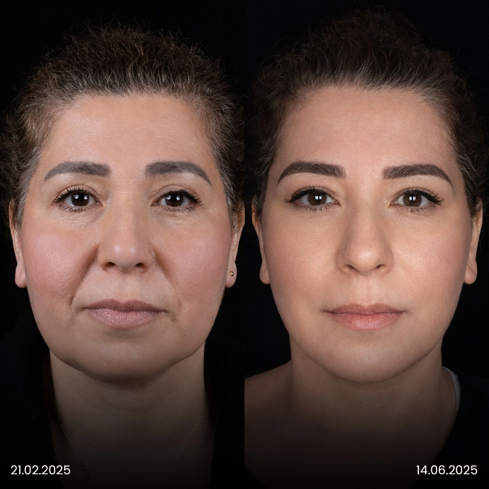 Risultato prima e dopo del lifting facciale 2