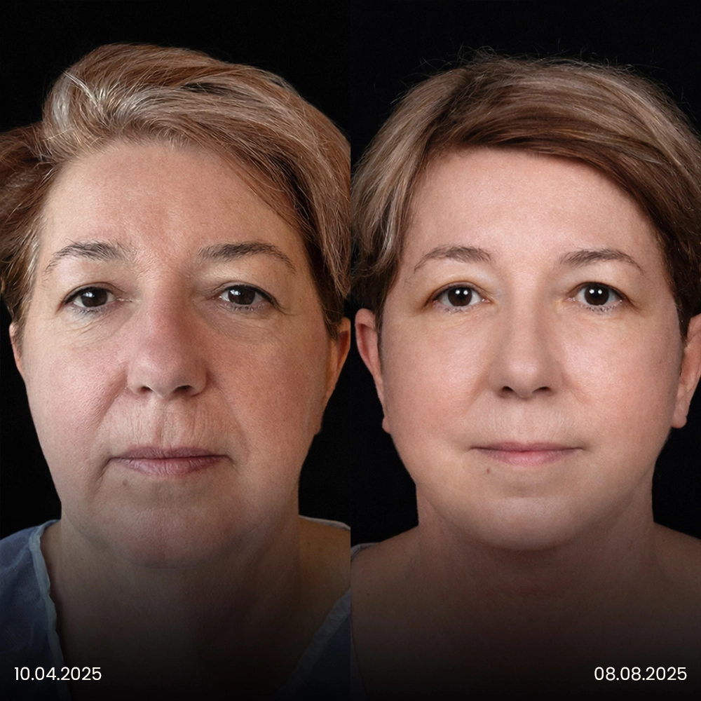 Risultato prima e dopo del lifting facciale 3