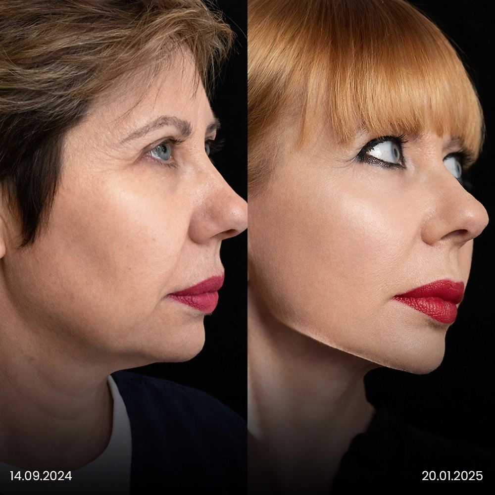 Risultato prima e dopo del lifting facciale 6