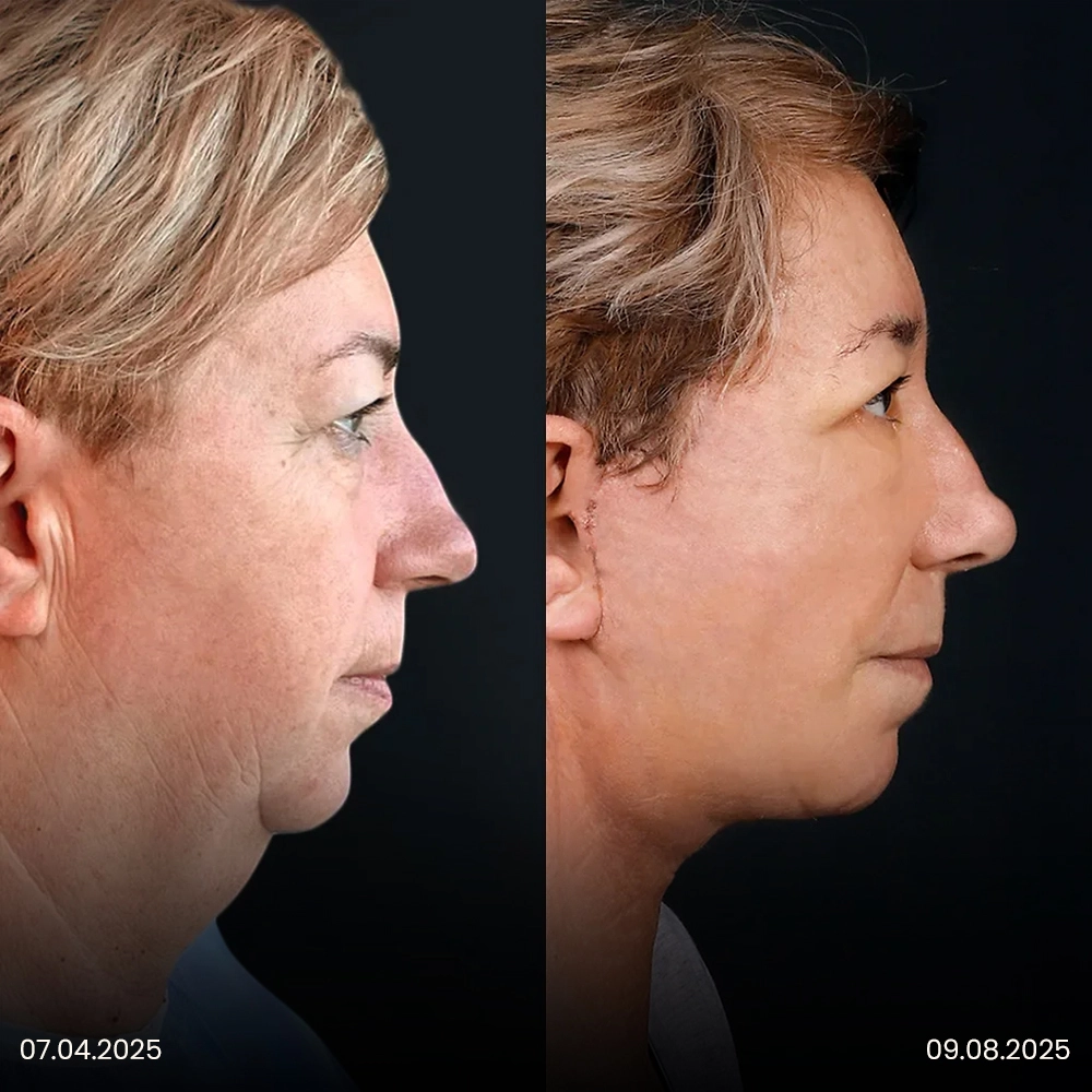 Risultato prima e dopo del lifting facciale 7