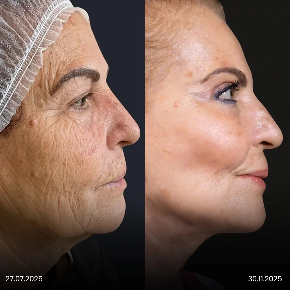 Risultato prima e dopo del lifting facciale 8
