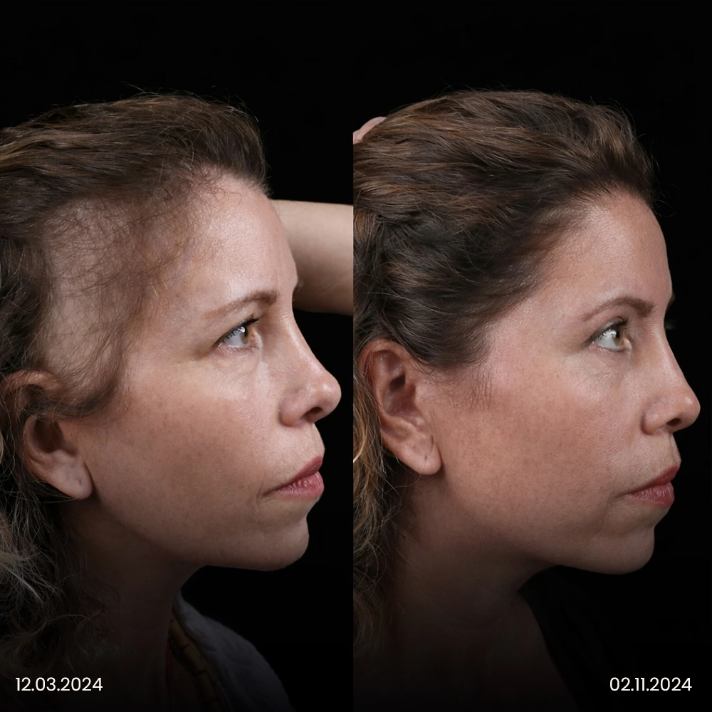 Risultato prima e dopo del trapianto di capelli femminile 1