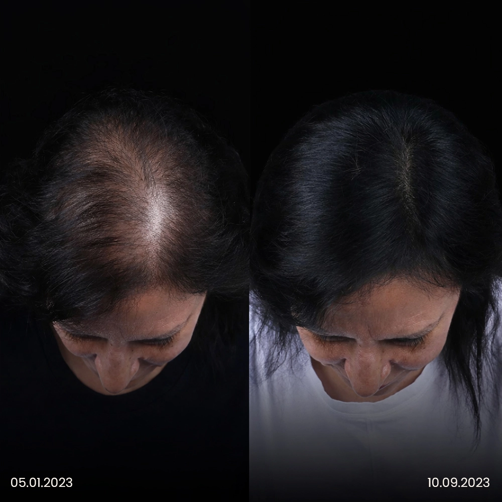Risultato prima e dopo del trapianto di capelli femminile 2