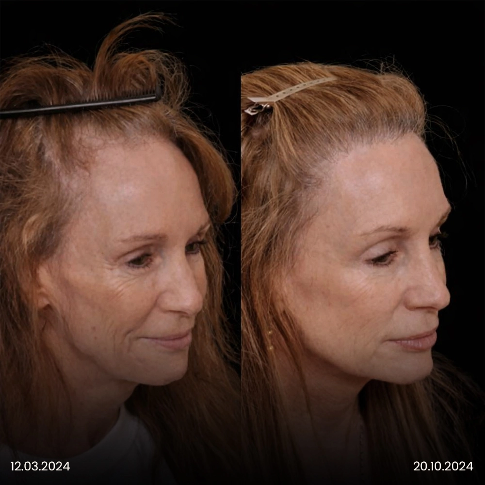 Risultato prima e dopo del trapianto di capelli femminile 3