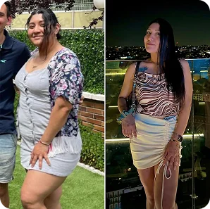 Palloncino gastrico prima e dopo, risultato 4