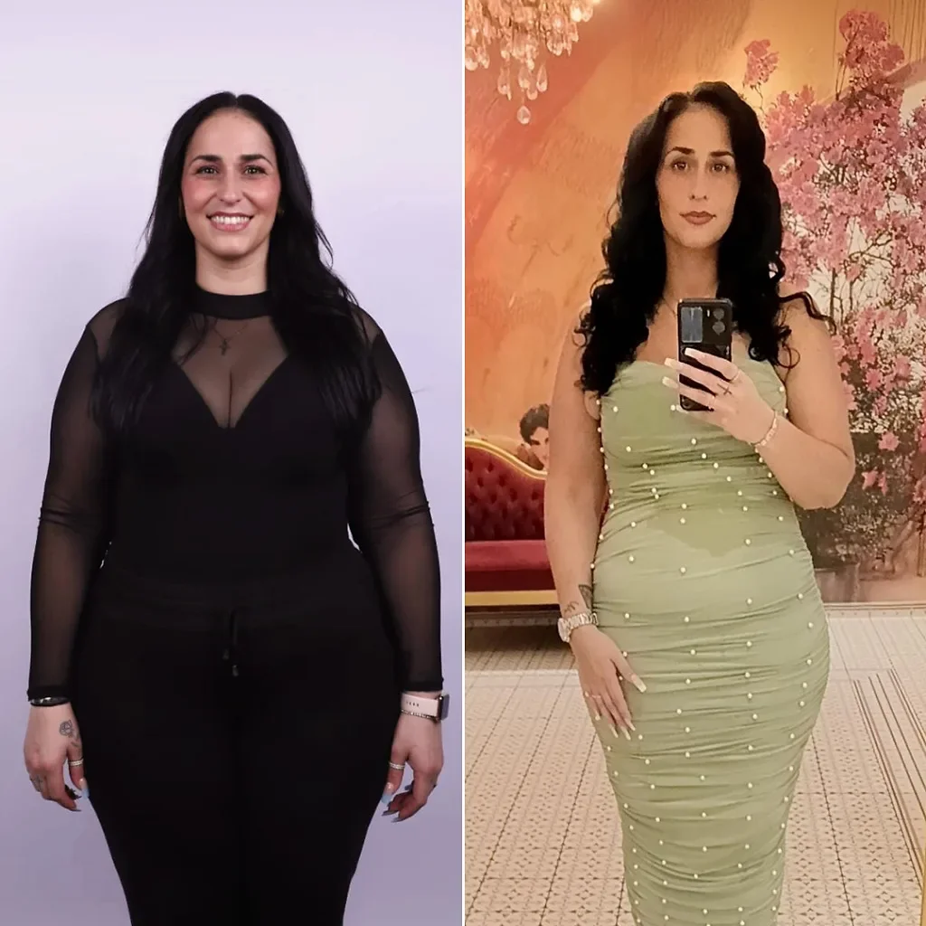Botox gastrico prima e dopo, risultato 17